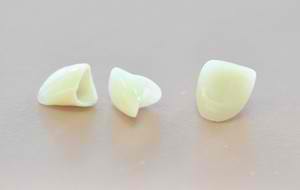 Shdc_Dental0Crowns-300X190 Dental treatments shepherds hill dental