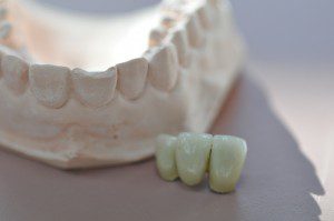 A dental bridge is just one of the options for replacing missing teeth