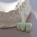 Cracked tooth repair: 4 dental options